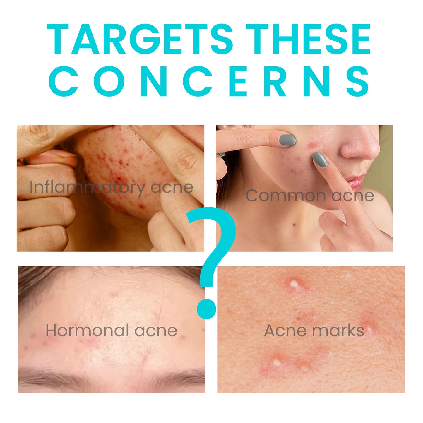 Jaysuing Brightening Acne Cream for Smooth Skin