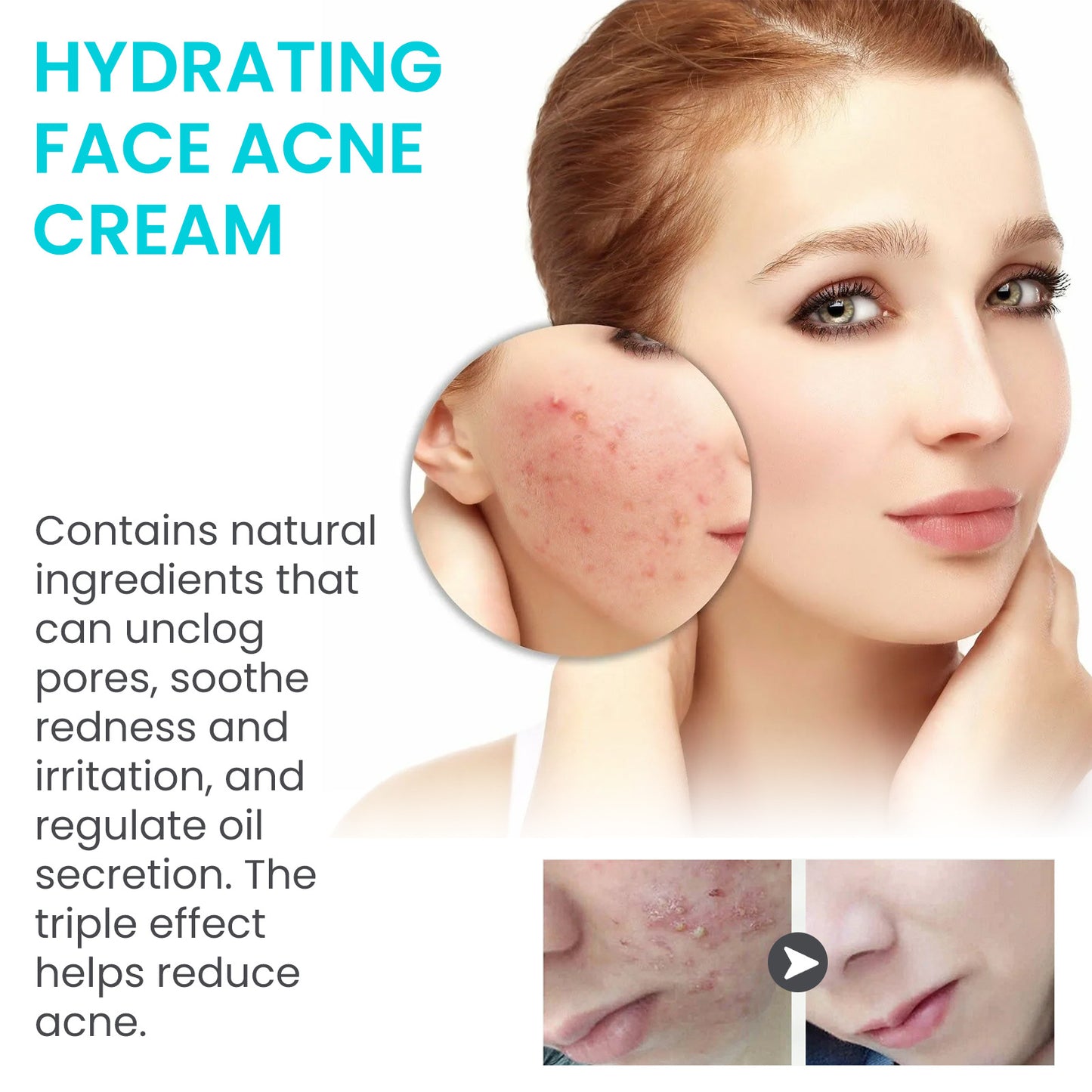 Jaysuing Brightening Acne Cream for Smooth Skin